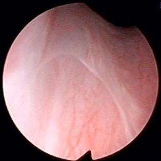 Ectopic ureter kimba0004 Ectopic ureter kimba0004
